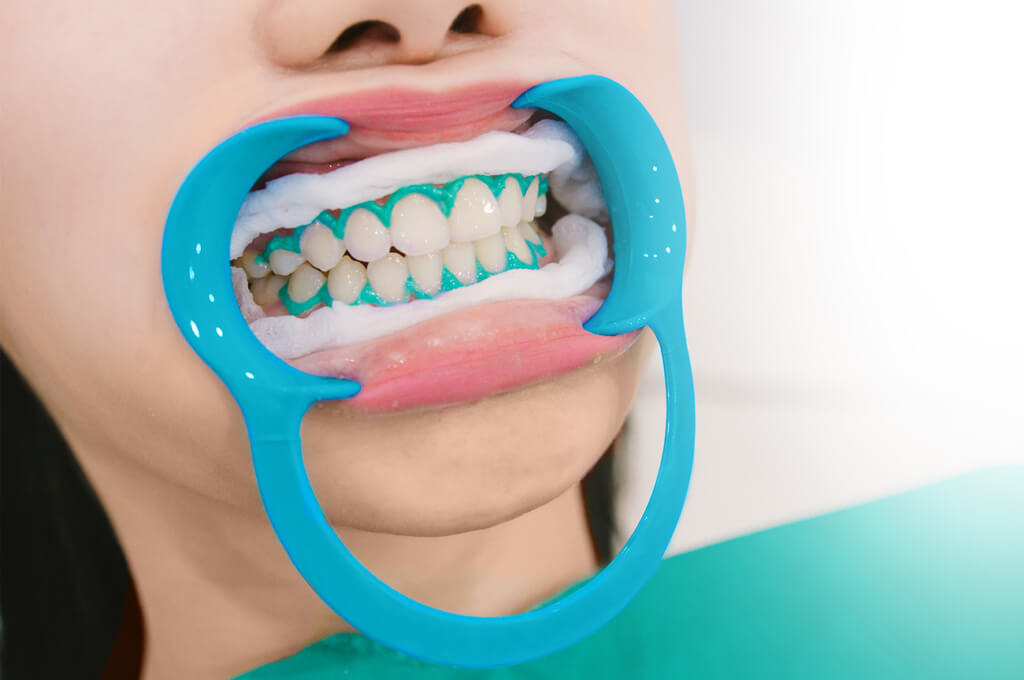 Izbjeljivanje zubi