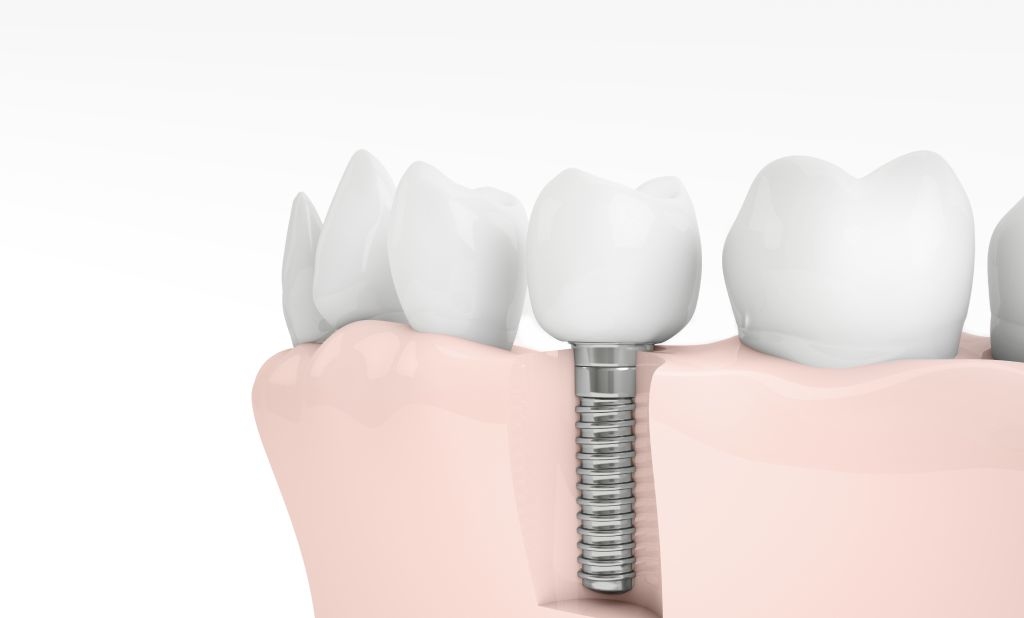 zubni implantati zadar