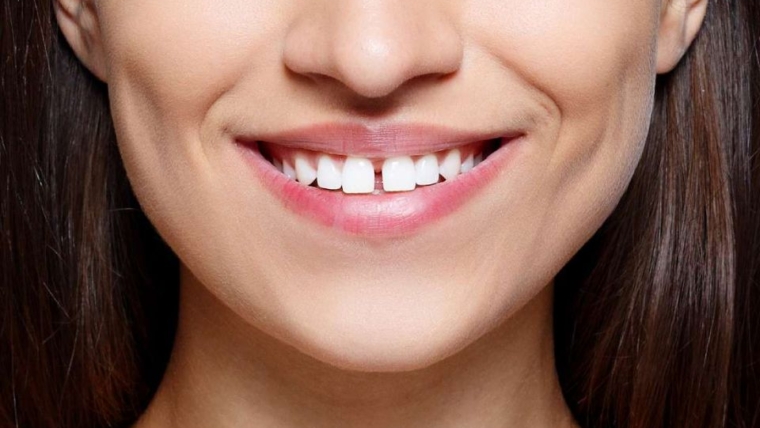 Dijastema ili razmak između zubi