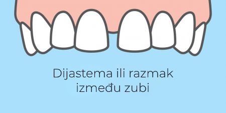 razmaknuti zubi