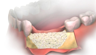 Što kad nema dovoljno kosti za implantate?