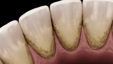 Čišćenje zubnog kamenca – važan čimbenik za oralno zdravlje