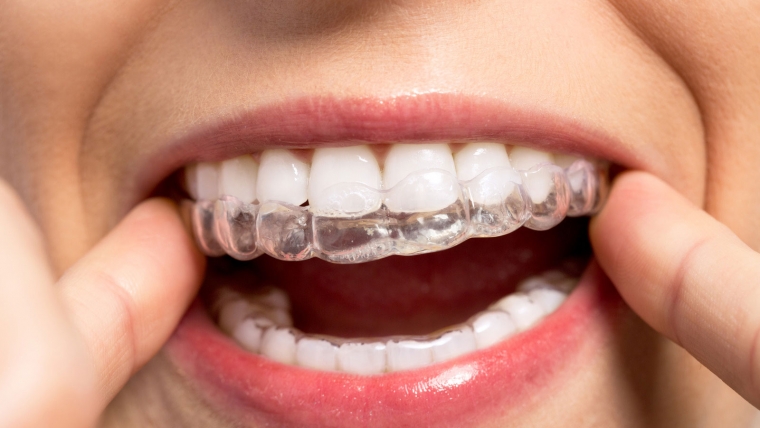 INVISALIGN® – ORTODONCIJA ZA 21. STOLJEĆE