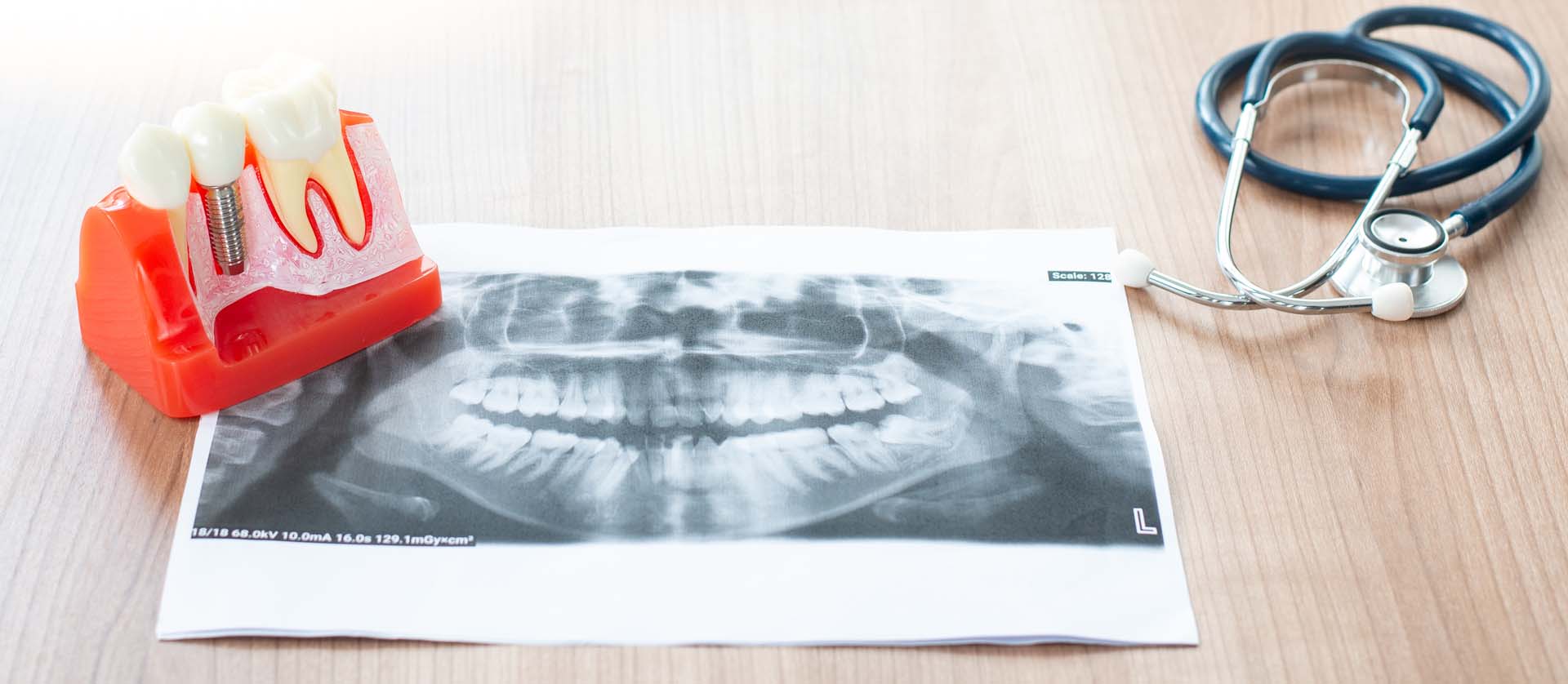 Odbacivanje zubnih implantata - razlozi i protokol