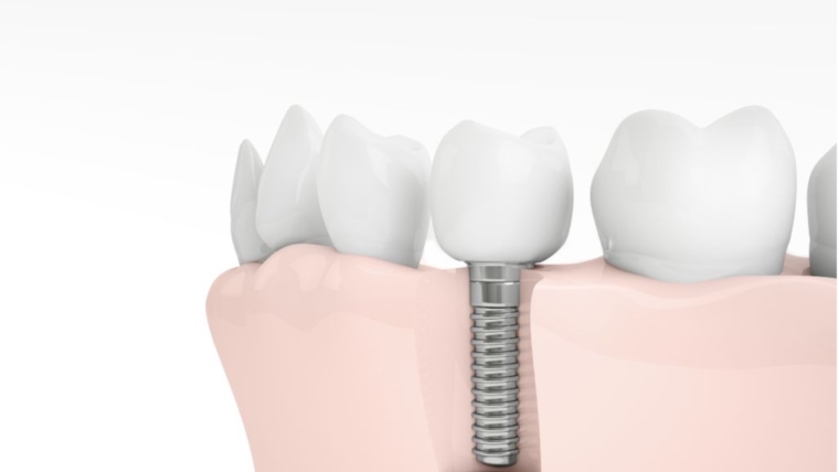 Rizici i komplikacije zubnih implantata: Kako ih izbjeći